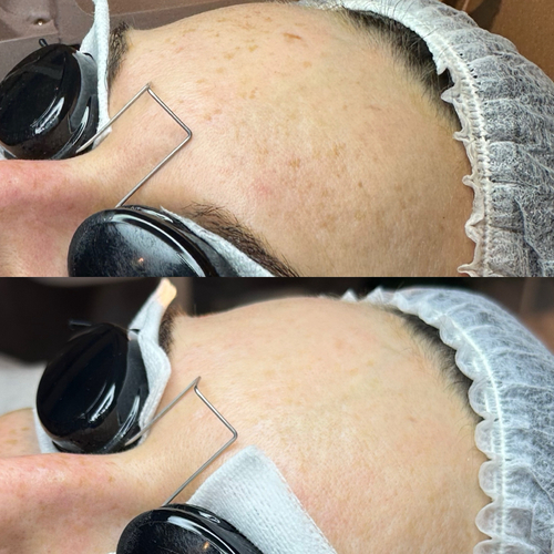 Treatment at Nika Alviri Skin Studio, a private skin studio in Bellevue, Nashville