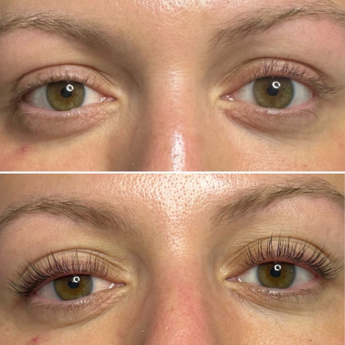 Treatment at Nika Alviri Skin Studio, a private skin studio in Bellevue, Nashville