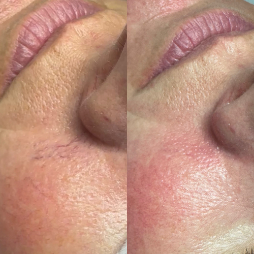 Treatment at Nika Alviri Skin Studio, a private skin studio in Bellevue, Nashville